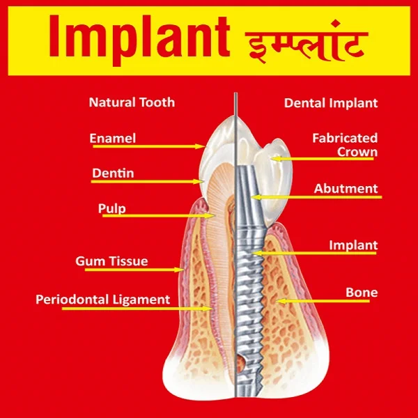 Dental Implant in Andheri | Dental Implant in Mumbai | Dental Treatment in Mumbai