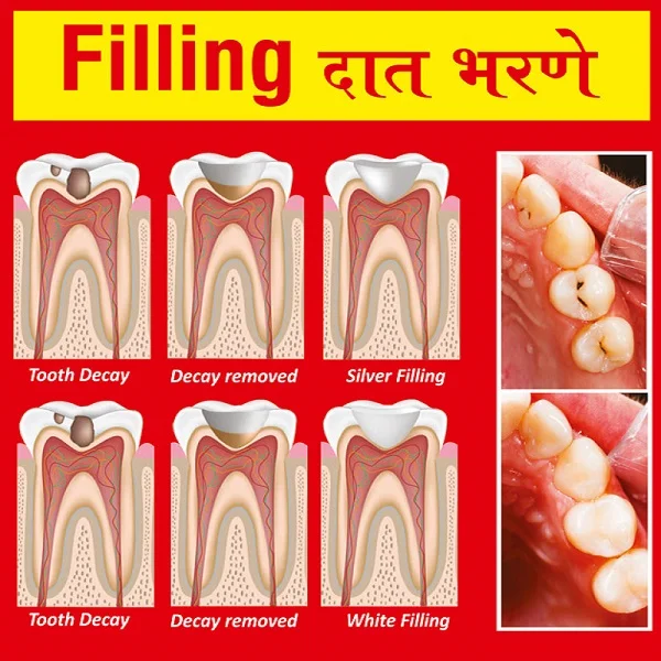 Dental Filling in Andheri | Dental Filling in Mumbai | Dental Treatment in Mumbai