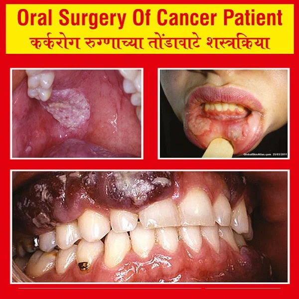 Oral Surgery in Andheri | Oral Surgery in Mumbai | Dental Treatment in Mumbai