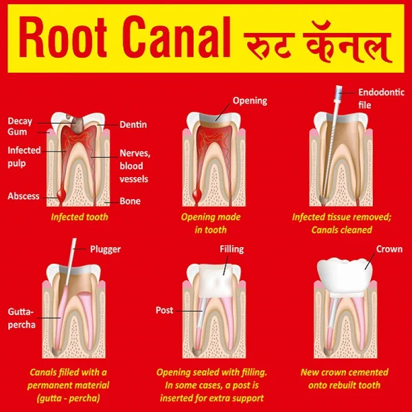 Root Canal in Andheri | Root Canal in Mumbai | Dental Treatment in Mumbai