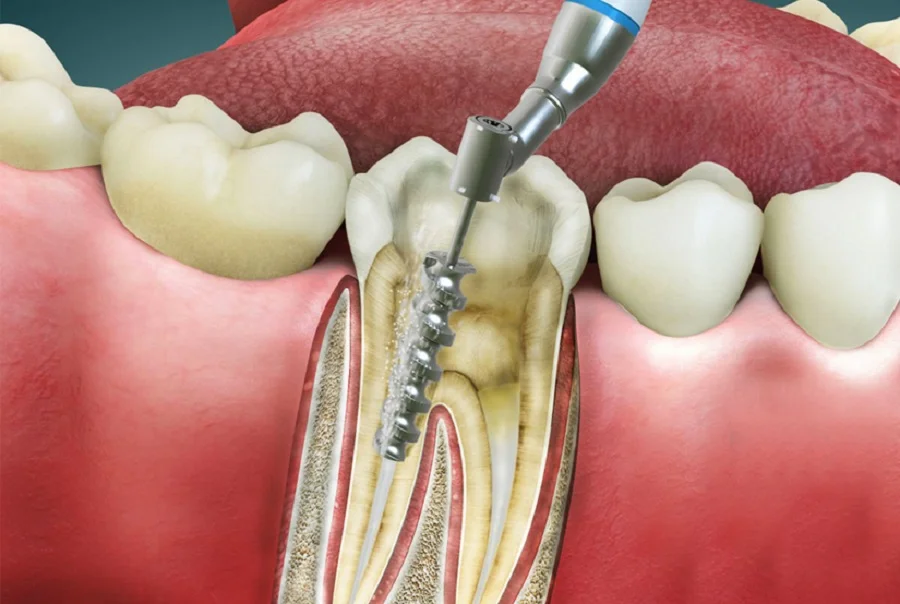 Root Canal in Andheri | Root Canal in Mumbai | Dental Treatment in Mumbai